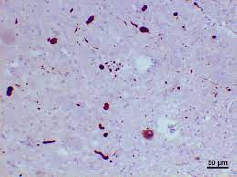(P-α-Syn) detected in skin biopsy for parkinsons disease