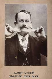 A man with ehler danlos syndrome