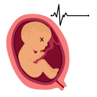 Intrauterine death (IUD)