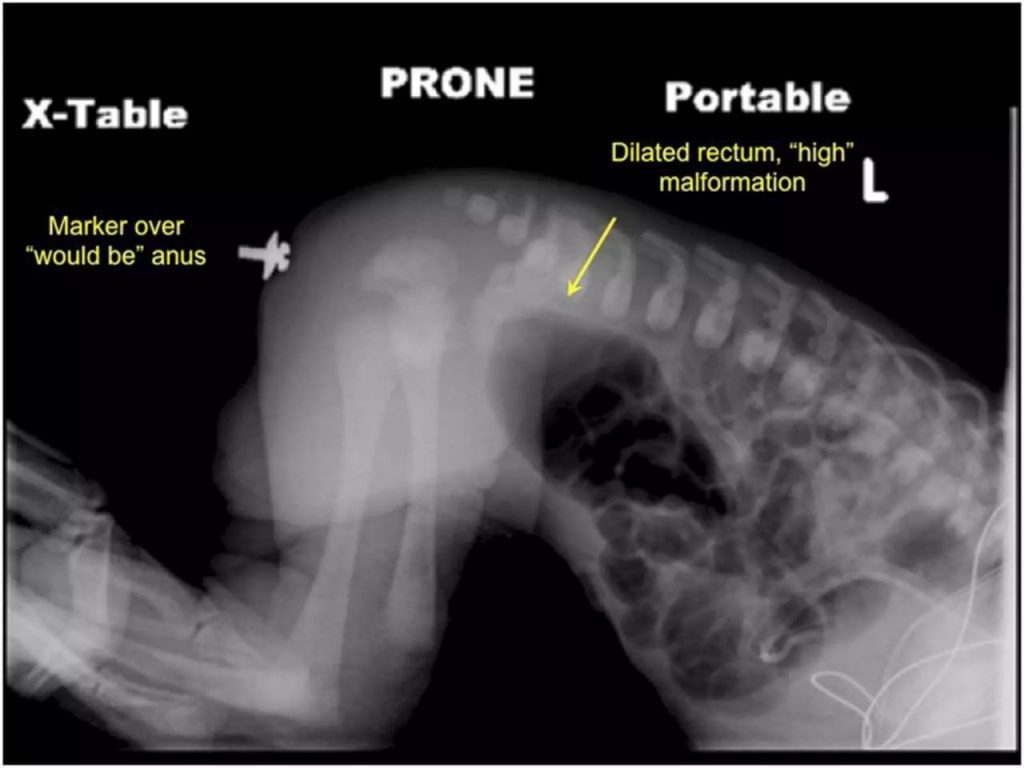 anorectal malformations imperforate anus diagnosis xray radiology