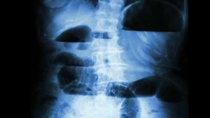 Closed loop obstruction featured image