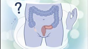 Anorectal malformations imperforate anus